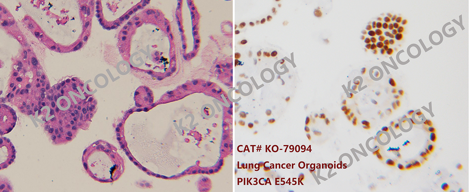 肺癌KO-79094类器官模型HE染色及IHC染色(PCNA)照片