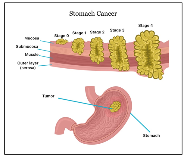 胃癌及进展分期图示.PNG