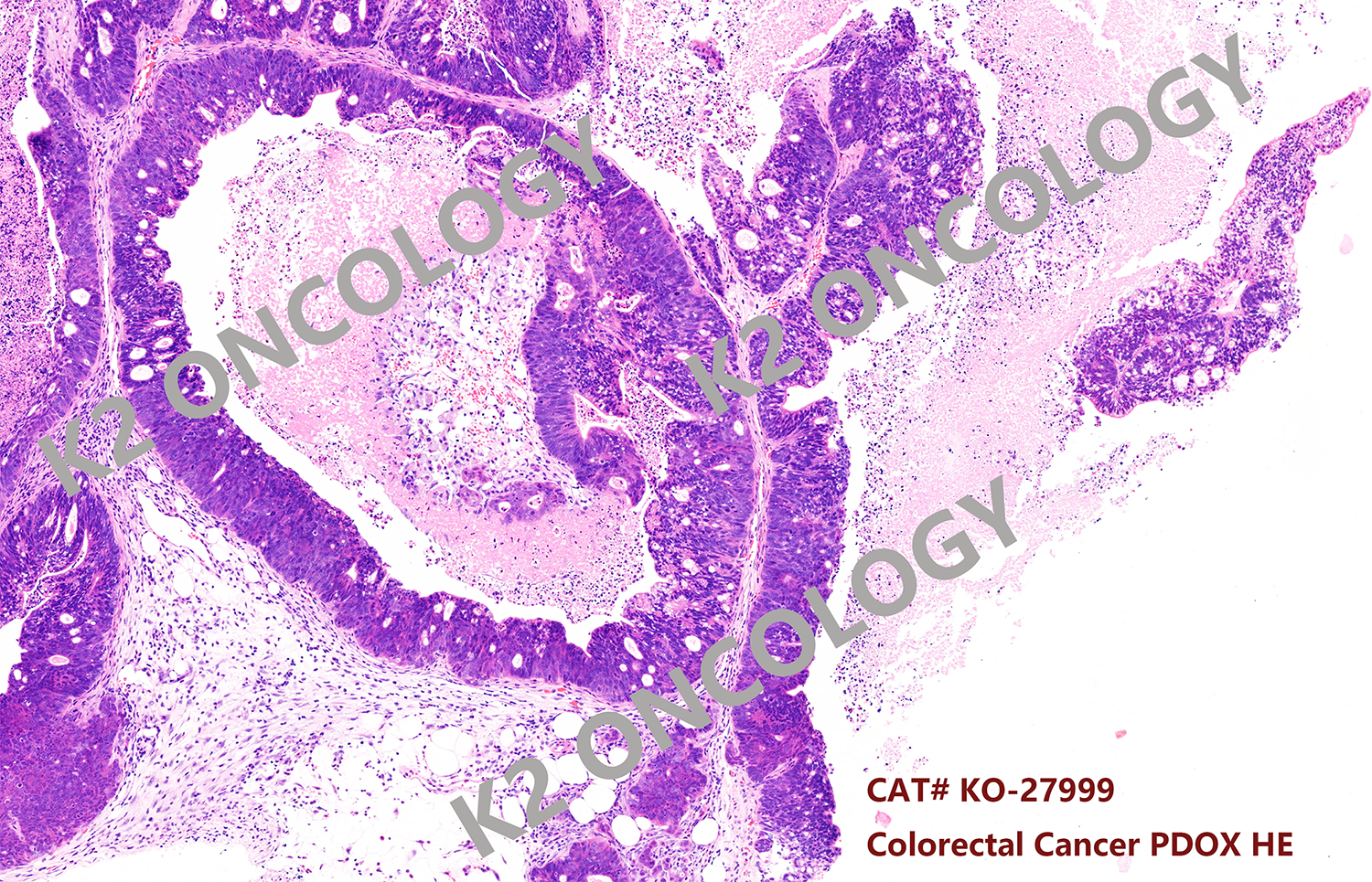 结直肠癌类器官KO-27999 PDOX小鼠模型的典型HE染色照片